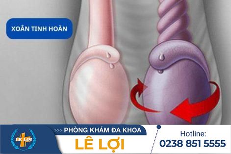 Xoắn tinh hoàn: chậm một giây hỏng cả đời!