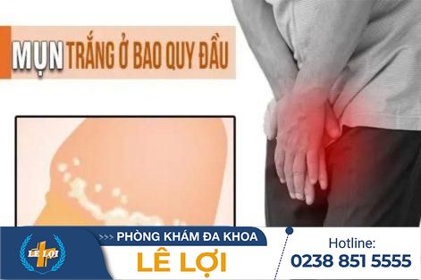 Hiện tượng bao quy đầu nổi mụn trắng là do đâu?