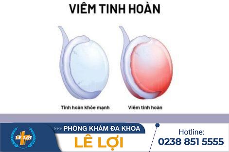 Viêm tinh hoàn mãn tính có chữa được không?