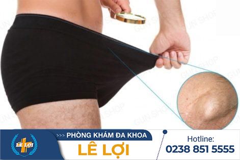 Dương vật nổi hạch là bị gì – Cần điều trị như thế nào?