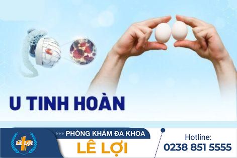 U tinh hoàn là gì – chữa trị ra sao- khám chữa dứt điểm tại Vinh