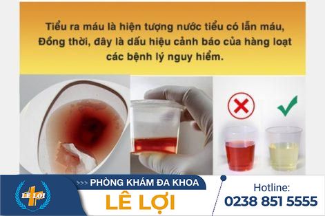 Làm thế nào để chữa trị tiểu ra máu?