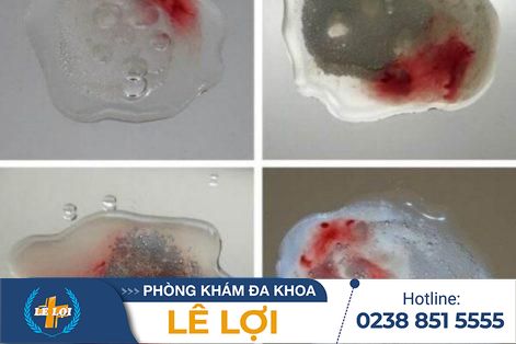 Cách nhận biết tinh dịch có màu đỏ