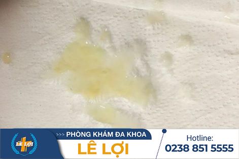 Chữa trị tinh dịch có màu vàng hiệu quả an toàn