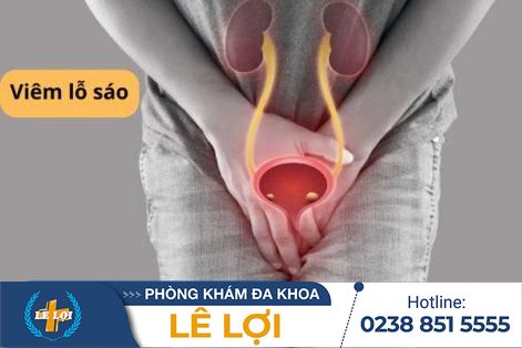 Địa chỉ điều trị viêm lỗ sáo an toàn và hiệu quả tại Vinh