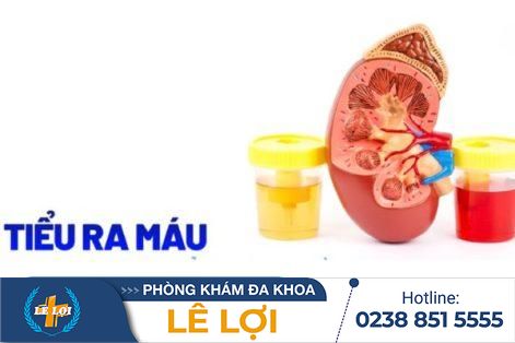 Tiểu ra máu là bị bệnh gì và cách điều trị ra sao?
