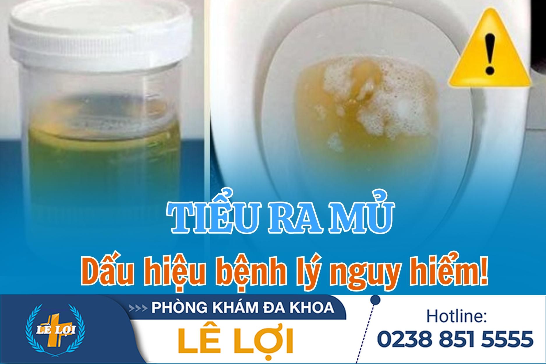 Tiểu ra mủ ở nam – dấu hiệu bệnh lý nguy hiểm cần phát hiện sớm